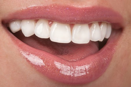 Blanchiment dentaire