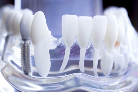 Implantologie dentaire